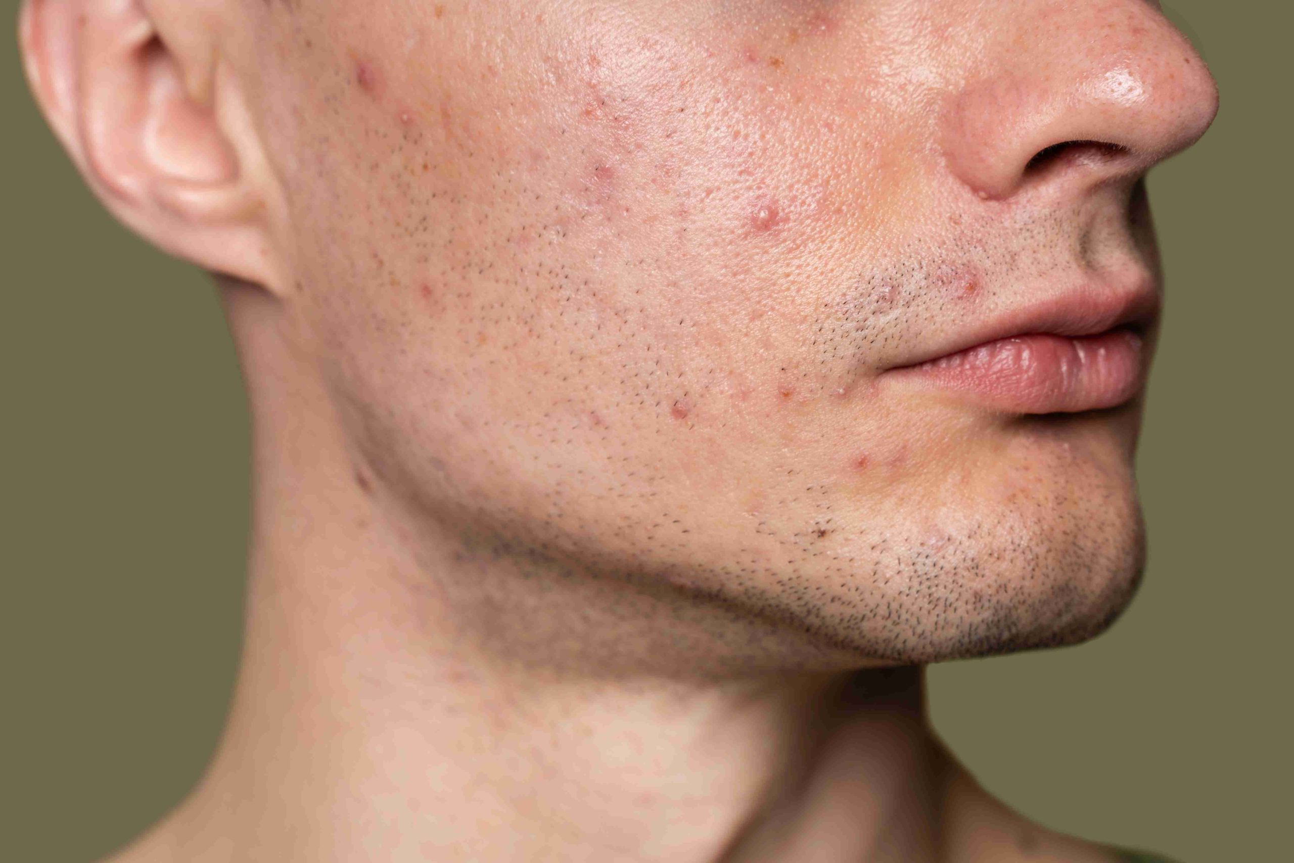 Pueraria Mirifica and Acne: Could It Affect Your Skin?
